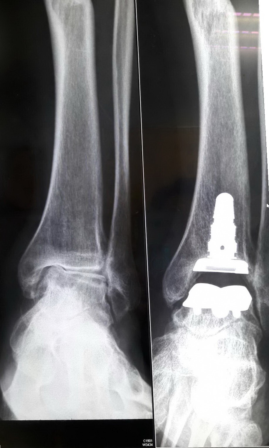人工全足踝关节置换手术1