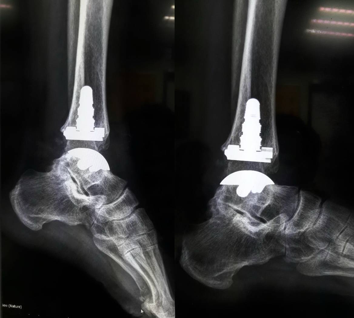 人工踝关节置换术2