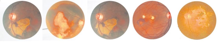 黄斑变性简单来说就是眼神经血管出血，令患者看不清视野中间影像。图为息肉状脉络膜血管病变（PCV）扫描影像。
