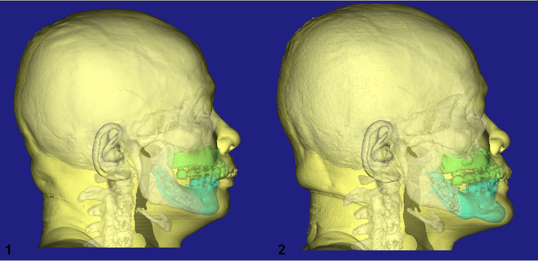 上下颚旋转推进术之3D手术模拟影像