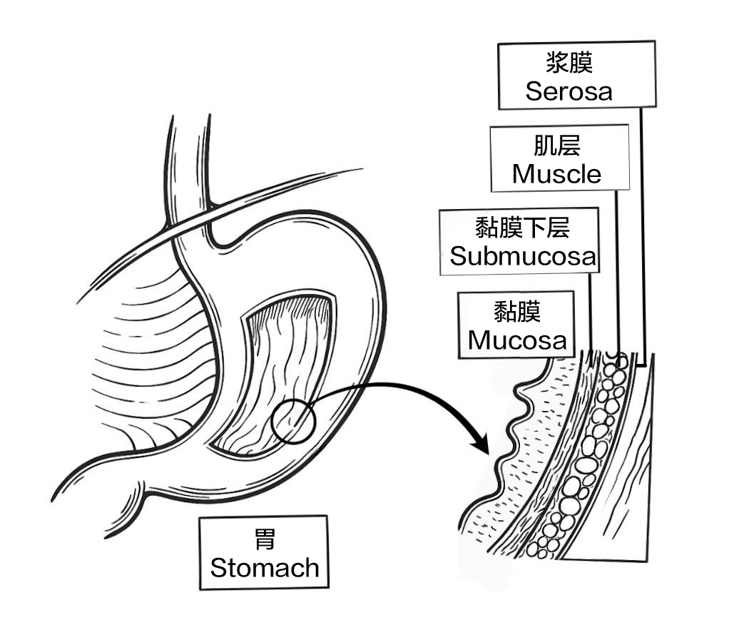 ESD无创剥离肠胃早癌 免终身挂“屎袋”