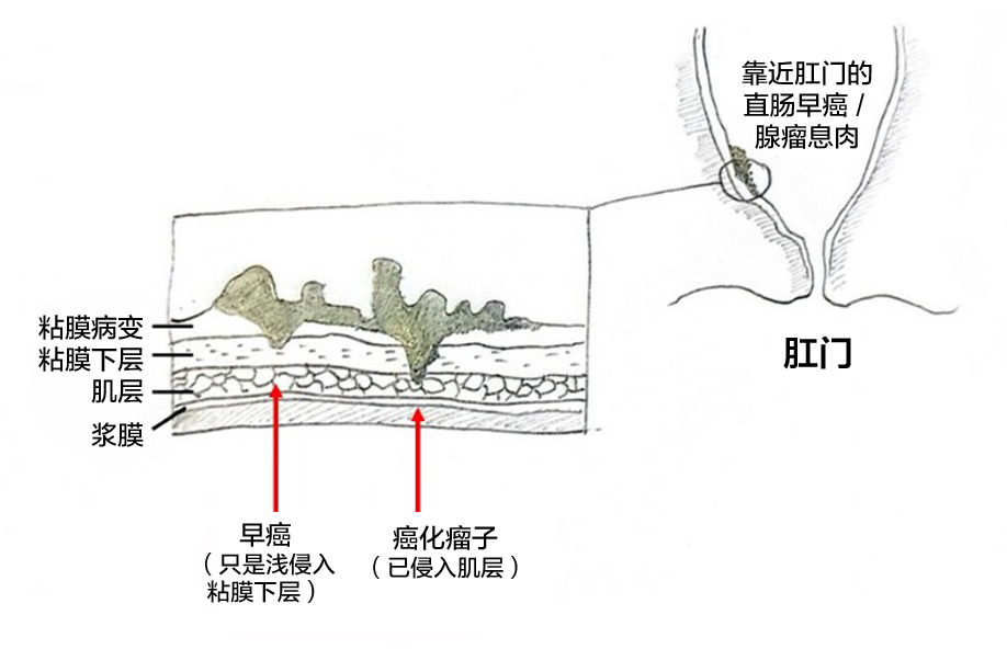 ESD无创剥离肠胃早癌 免终身挂“屎袋”