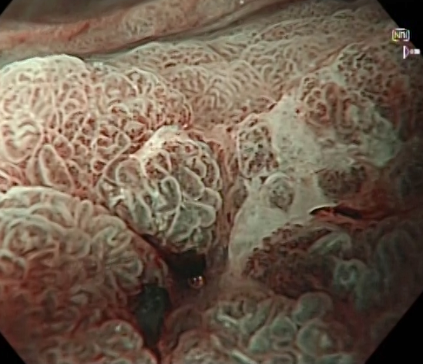 ESD无创剥离肠胃早癌 免终身挂“屎袋”