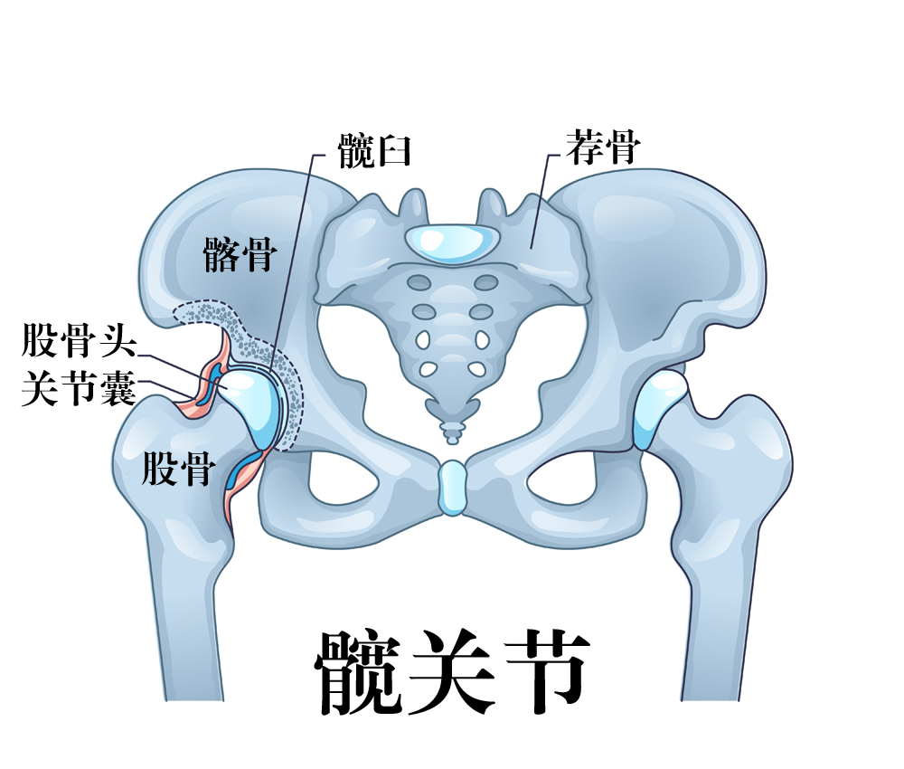 腰痛不等同坐骨痛 髋关节疾病易忽视