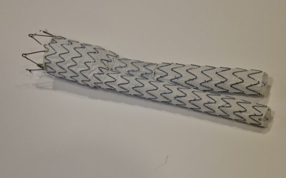 藏在体内的计时炸弹 腹主动脉瘤 一旦破裂死亡风险高