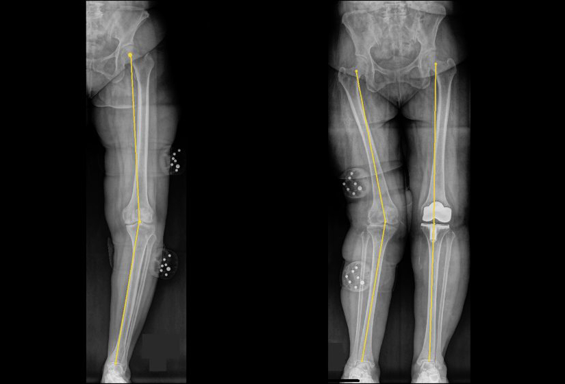 O型腿非病必治 严重才做胫骨截骨术