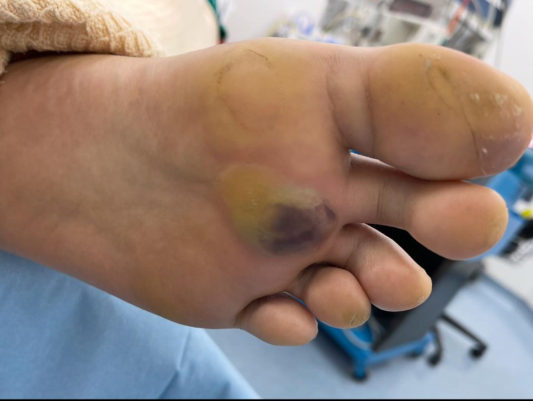 鸡眼与茧并非小问题 糖友更要小心防 长期恐引发感染溃疡