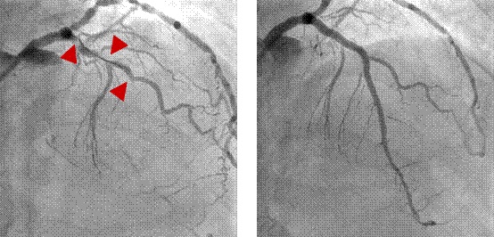 心导管有效治疗冠状动脉阻塞