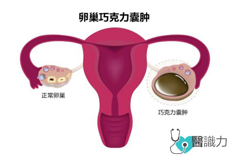 问医, 林韵璇, 反式脂肪, 高糖, 发炎 巧克力囊肿, 卵巢巧克力囊肿, 饮食禁忌, chocolate cyst