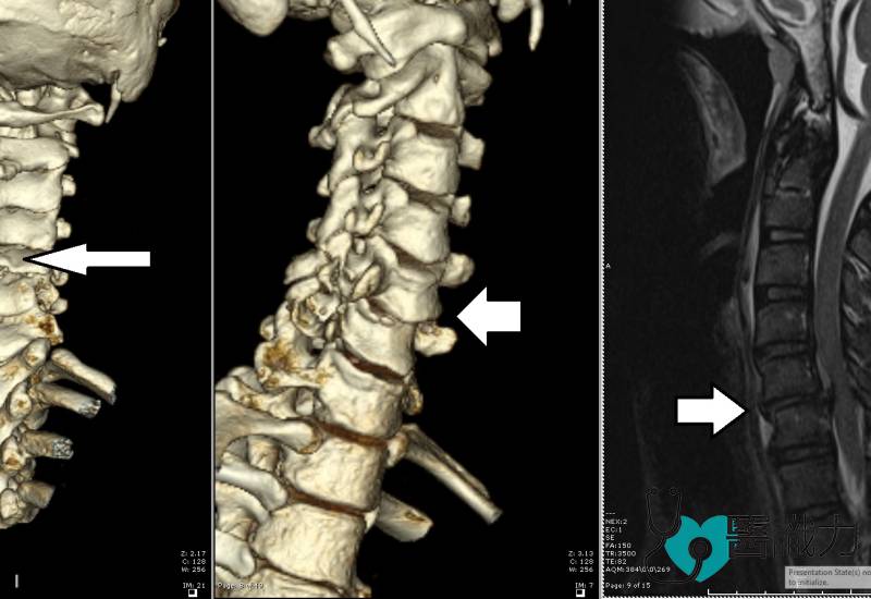 问医-盛晓峰-脊椎伤者勿乱动-错误搬运恐瘫痪