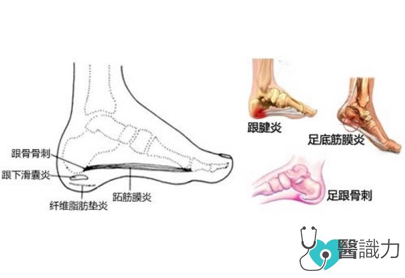 足底长期不正常受力 易患跟痛症 医识力 足底长期不正常受力 易患跟痛症 医识力