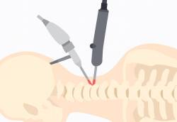 问医-盛晓峰-双孔内视镜微创手术-逆转颈椎弧形-缓解颈臂疼痛